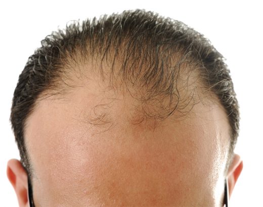 ¿Sufres caída de cabello?… ¡Sigue estos tips!